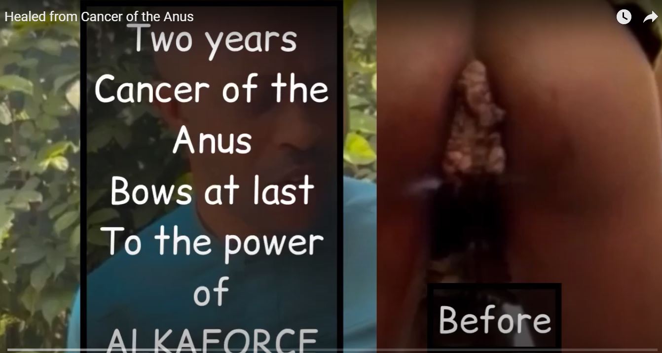 Cancer of the Anus wiped out completely